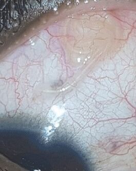 A NEOflorax segített megszabadulni egy féregtől a szemben